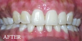Laser Gum Bleaching Philadelpia